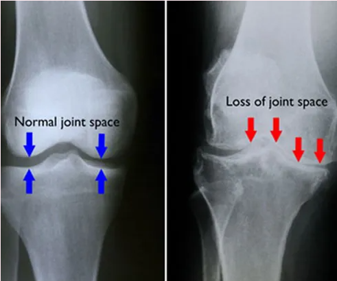 X-ray showing side by side comparison of knee joint with no space and know joint with space.